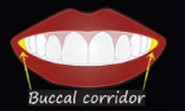 Buccal-corridors