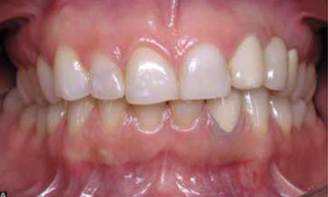 Dental-midline-and-teeth-angulationA