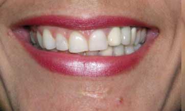 Dental-midline-and-teeth-angulationB