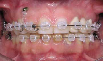Dental-midline-and-teeth-angulationC