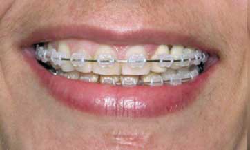 Dental-midline-and-teeth-angulationD