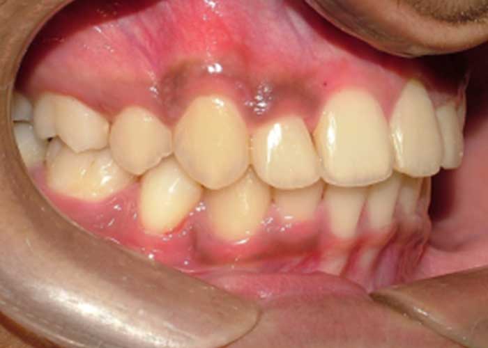 Maxillary-Incisor-Crowding-2After