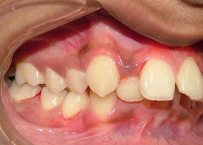 Maxillary-Incisor-Crowding-2before