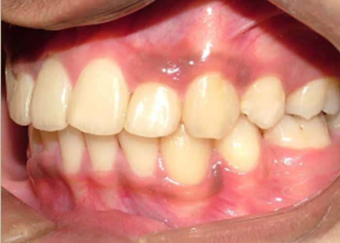 Maxillary Incisor Crowding 3After