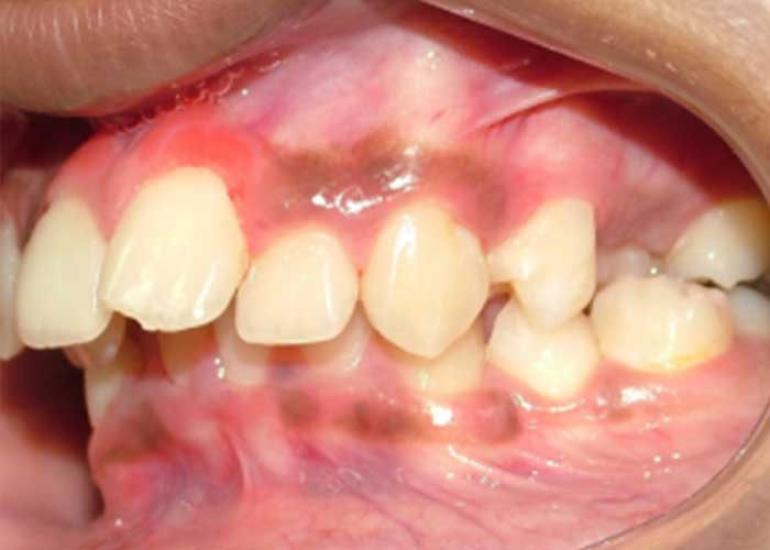 Maxillary-Incisor-Crowding-3before