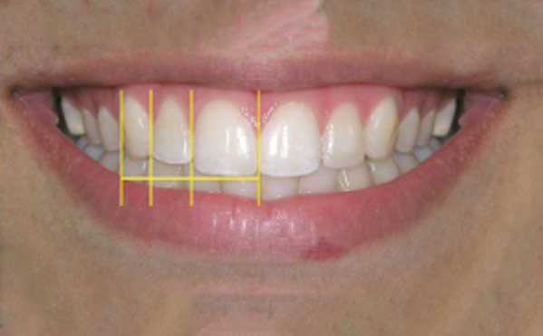 Smile-with-golden-ratio-(62%)-between-teeth-in-the-esthetic-zone1