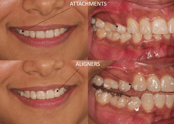 attachment-placement-and-aligner-delivery