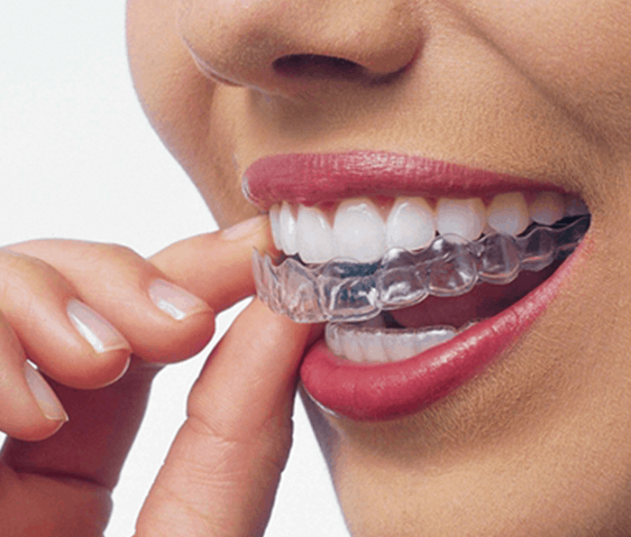 clear-Aligners
