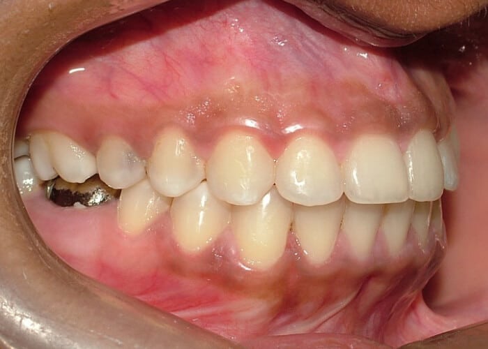 front-teeth-crowding-and-bad-bite-after1