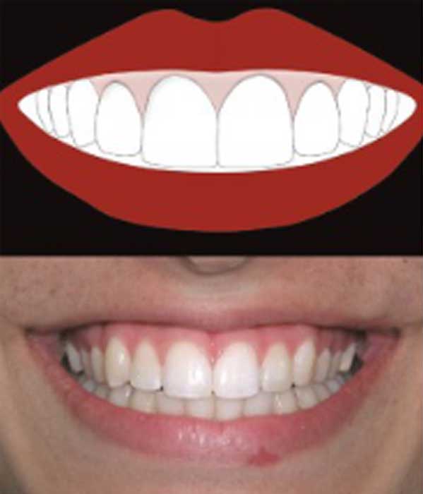 high-smile,-characterized-by-total-exposure-of-clinical-crowns-and-continuous-strip-of-gingival-tissue