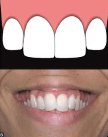 long-teeth-with-ratio