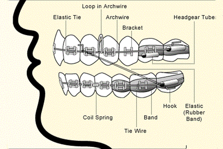 loose-brackets-wires