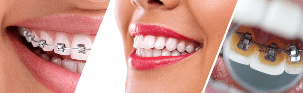 Orthodontic Appliance Selection And Placement Smiles N Faces