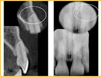 accurate assessment of root position and root anatomy. Early diagnosis of root resorption, fenestrations and dehiscences.