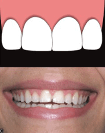 short-or-squared-teeth